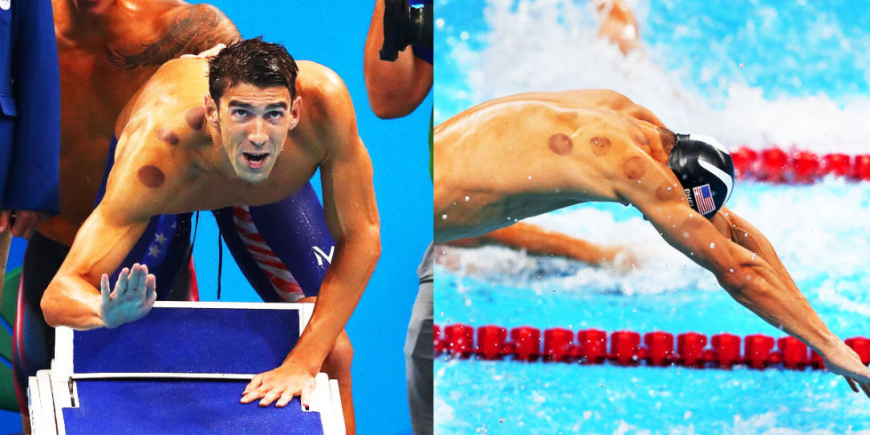 Micheal Phelps alle Olimpiadi di Rio 2016 presentava i normali segni di un trattamento con la coppettazione.
